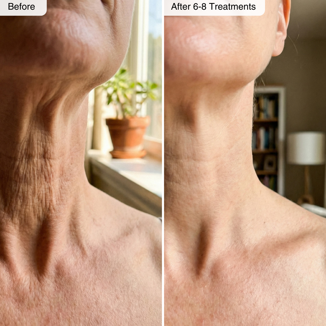 ReForme™ - Micro-Infusion Kit